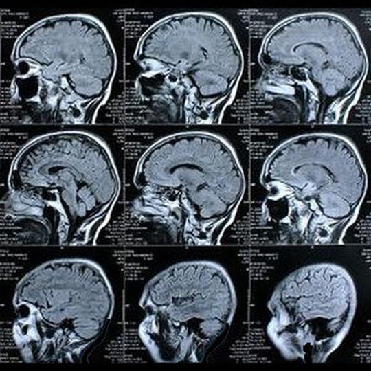 Gehirnscans: Forscher erhoffen sich von dem neuen Chip noch tiefere Einblicke in die Funktion des menschlichen Gehirns