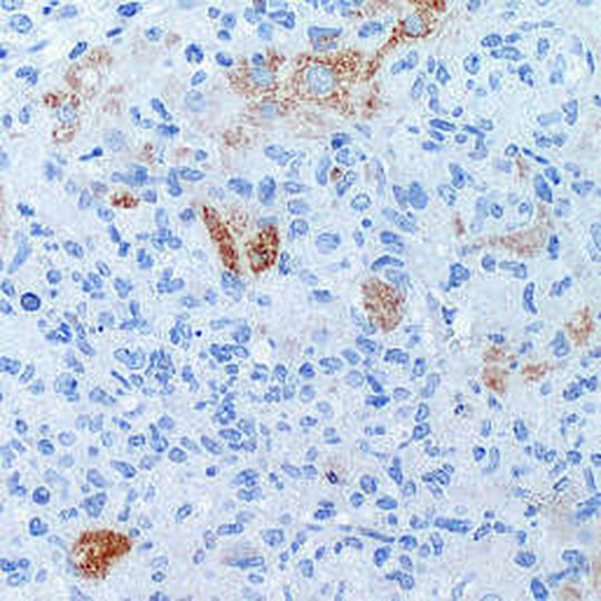 Leberzellen unter dem Mikroskop. Apoptotische Zellen sind braun gefärbt, Zellkerne blau. Leberzellen unter dem Mikroskop. Apoptotische Zellen sind braun gefärbt, Zellkerne blau.