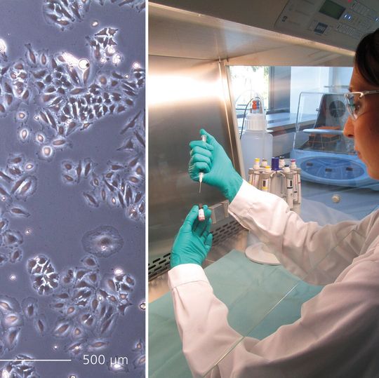 Gebärmutterhalskarzinomzellen lassen sich mit in Nanopartikel verkapseltem Krebs-Wirkstoff effektiv und zielgenau abtöten (links). Hier wird der Wirkstoff Doxorubicin vorbereitet – ein in der Chemotherapie häufig verwendetes Medikament (rechts). Gebärmutterhalskarzinomzellen lassen sich mit in Nanopartikel verkapseltem Krebs-Wirkstoff effektiv und zielgenau abtöten (links). Hier wird der Wirkstoff Doxorubicin vorbereitet – ein in der Chemotherapie häufig verwendetes Medikament (rechts).