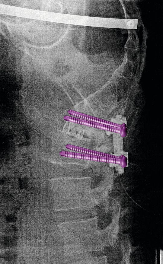 Titanimplantate: Denis During trägt Implantate aus Titan im Rücken. Damit bei diesen Operationen auch die richtigen Elemente zum Einsatz kommen, sind sie eingefärbt. Titanimplantate: Denis During trägt Implantate aus Titan im Rücken. Damit bei diesen Operationen auch die richtigen Elemente zum Einsatz kommen, sind sie eingefärbt.