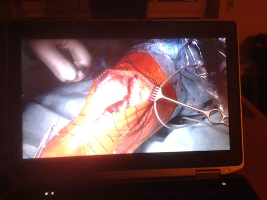 Fehlerhafte Implantate führen laut Reportage des TV-Senders Arte unnötig häufig zu Revisionsoperationen. Fehlerhafte Implantate führen laut Reportage des TV-Senders Arte unnötig häufig zu Revisionsoperationen.