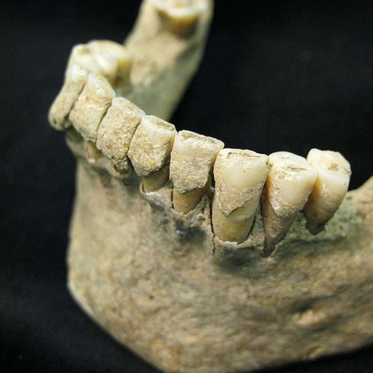 Zahnstein bei einem Mann, der im Mittelalter in Dalheim lebte. Zahnstein bei einem Mann, der im Mittelalter in Dalheim lebte.