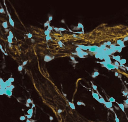 Die Immunfluoreszenzmikroskopische Aufnahme von UV-bestrahltem, entzündetem Hautgewebe zeigt grün fluoreszierende Melanomzellen, die sich auf rot fluoreszierenden Oberflächen von kleinen Blutgefäßen ausbreiten. Die Immunfluoreszenzmikroskopische Aufnahme von UV-bestrahltem, entzündetem Hautgewebe zeigt grün fluoreszierende Melanomzellen, die sich auf rot fluoreszierenden Oberflächen von kleinen Blutgefäßen ausbreiten.