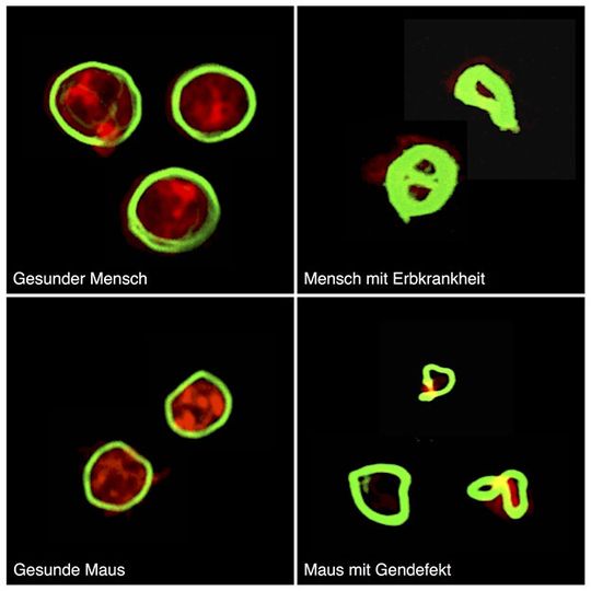 Blutplättchen von gesunden Menschen (oben) und Mäusen (unten) besitzen ein dichtes Zellskelett (rot), das von einem Ring aus sogenannten Mikrotubuli (grün) umsäumt ist. Bei Wiskott-Aldrich-Patienten und bei Mäusen mit einem Gendefekt an Profilin1 ist das Zellskelett kaum ausgeprägt; der Mikrotubuli-Ring ist verdickt und verdrillt. Blutplättchen von gesunden Menschen (oben) und Mäusen (unten) besitzen ein dichtes Zellskelett (rot), das von einem Ring aus sogenannten Mikrotubuli (grün) umsäumt ist. Bei Wiskott-Aldrich-Patienten und bei Mäusen mit einem Gendefekt an Profilin1 ist das Zellskelett kaum ausgeprägt; der Mikrotubuli-Ring ist verdickt und verdrillt.
