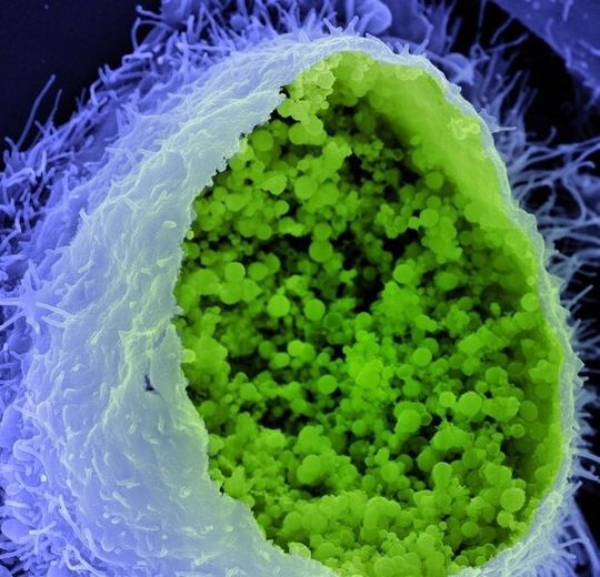 Eine Chlamydien-Infektion (in der Mikroskopaufnahme grün) begünstigt Prozesse der Krebsentstehung. Eine Chlamydien-Infektion (in der Mikroskopaufnahme grün) begünstigt Prozesse der Krebsentstehung.