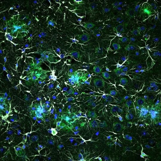 Diese Aufnahme zeigt die Gewebeprobe einer Maus mit Merkmalen der Alzheimer-Erkrankung. Die Ausläufer sogenannter Astrozyten erscheinen weiß. Astrozyten unterstützen die Funktion von Neuronen und sind unter anderem an der Regelung der Hirndurchblutung beteiligt. Bei Alzheimer verändern diese Zellen ihre Gestalt und Aktivität. Ebenfalls im Bild: die Zellkerne (blau) von Astrozyten, Neuronen und anderen Zellen. Die grünen Farbtupfer stammen von einem Protein, das mit der Alzheimer-Erkrankung in Verbindung steht. Diese Aufnahme zeigt die Gewebeprobe einer Maus mit Merkmalen der Alzheimer-Erkrankung. Die Ausläufer sogenannter Astrozyten erscheinen weiß. Astrozyten unterstützen die Funktion von Neuronen und sind unter anderem an der Regelung der Hirndurchblutung beteiligt. Bei Alzheimer verändern diese Zellen ihre Gestalt und Aktivität. Ebenfalls im Bild: die Zellkerne (blau) von Astrozyten, Neuronen und anderen Zellen. Die grünen Farbtupfer stammen von einem Protein, das mit der Alzheimer-Erkrankung in Verbindung steht.