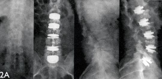 Biokompatibilität und eine auf die Anatomie abgestimmte Elastizität können von einem lasergeschmolzenen Käfig ausgezeichnet abgebildet werden. Biokompatibilität und eine auf die Anatomie abgestimmte Elastizität können von einem lasergeschmolzenen Käfig ausgezeichnet abgebildet werden.