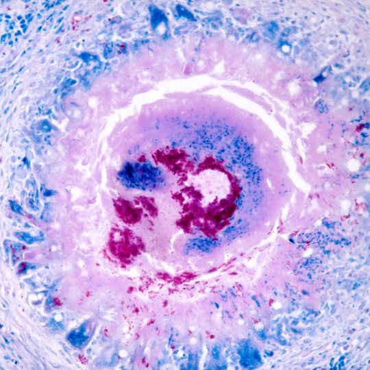 TEM-Aufnahme: Tuberkulose-Granulom mit Mykobakterien. TEM-Aufnahme: Tuberkulose-Granulom mit Mykobakterien.