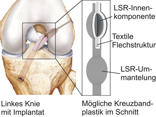 Verbundstruktur eines biomimetischen Kreuzbandersatzes. Verbundstruktur eines biomimetischen Kreuzbandersatzes.