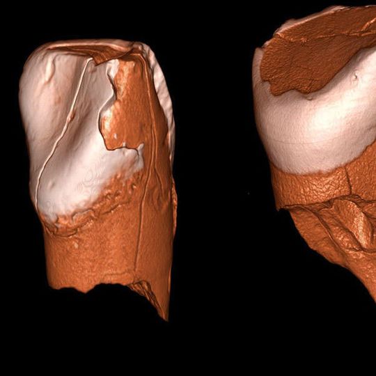 Dreidimensionale digitale Modelle des unteren Schneidezahns aus Riparo Bombrini (links) und des oberen Schneidezahns aus der Grotta di Fumane (rechts). Bei beiden Zähnen handelt es sich um Milchzähne (Ausschnitt). Dreidimensionale digitale Modelle des unteren Schneidezahns aus Riparo Bombrini (links) und des oberen Schneidezahns aus der Grotta di Fumane (rechts). Bei beiden Zähnen handelt es sich um Milchzähne (Ausschnitt).