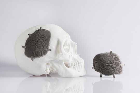 Schädelimplantat aus Titan: Die Porosität des Implantats beträgt 95 Prozent, sodass Flüssigkeiten mit wenig Widerstand abfließen und das Knochengewebe mit den Außenrändern verwachsen kann. Schädelimplantat aus Titan: Die Porosität des Implantats beträgt 95 Prozent, sodass Flüssigkeiten mit wenig Widerstand abfließen und das Knochengewebe mit den Außenrändern verwachsen kann.