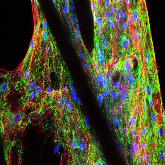 Konfokale Lasermikroskopie eines mit menschlichen mesenchymalen Vorläuferzellen besiedelten Gerüstes (Scaffold). Konfokale Lasermikroskopie eines mit menschlichen mesenchymalen Vorläuferzellen besiedelten Gerüstes (Scaffold).