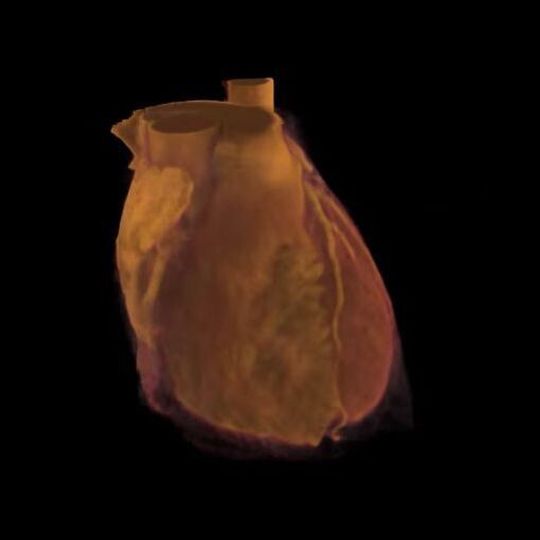 Das menschliche Herz in Aktion: Fachleute haben mit einer speziellen Software eine 3-D-Sequenz des Herzens erstellt. Das menschliche Herz in Aktion: Fachleute haben mit einer speziellen Software eine 3-D-Sequenz des Herzens erstellt.