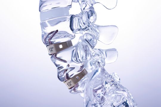 Rückenimplantate aus Peek: Für ihre Produktion hat Samaplast unter anderem reinraumtaugliche Spritzgießwerkzeuge konstruiert und gebaut. Rückenimplantate aus Peek: Für ihre Produktion hat Samaplast unter anderem reinraumtaugliche Spritzgießwerkzeuge konstruiert und gebaut.