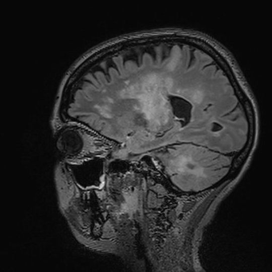 Entzündungsherde (helle Zonen) im Gehirn von Multiple-Sklerose-Patienten, die an einer progressiven multifokalen Leukoenzephalopathie (PML) erkrankt sind. Entzündungsherde (helle Zonen) im Gehirn von Multiple-Sklerose-Patienten, die an einer progressiven multifokalen Leukoenzephalopathie (PML) erkrankt sind.