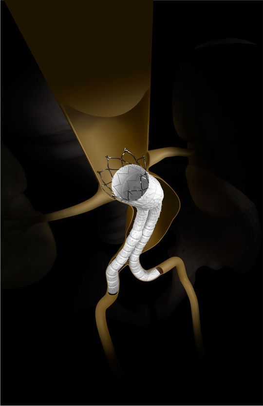 Cardinal Health wird Cordis-Produkte weiterhin unter dem Markennamen Cordis verkaufen – wie dieses Stent-System mit dem Namen Cordis Incraft AAA Stent Graft System. Cardinal Health wird Cordis-Produkte weiterhin unter dem Markennamen Cordis verkaufen – wie dieses Stent-System mit dem Namen Cordis Incraft AAA Stent Graft System.