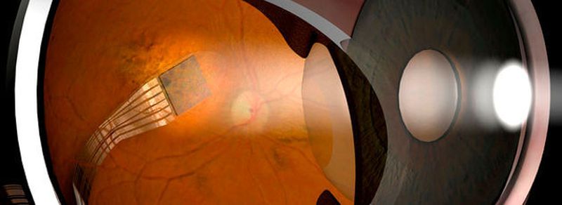 Netzhaut-Chip der Firma Retina Implant im menschlichen Auge: Der drei mal drei Millimeter kleine Chip mit 1500 Fotoelektroden wird unter der Netzhaut platziert und wandelt Lichtreize in elektrische Impulse um. Das Ladungsbild wird dann über den Sehnerv an das Gehirn geleitet. Die Stromversorgung erfolgt über eine dünne Leitung (unten rechts im Bild), die zu einer am Hinterkopf unter der Haut angebrachten Spule führt.