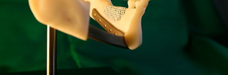 Patientenspezifische Implantate wie diese gibt es auf der Rapidtech zu sehen: eine 3D-gedruckte Knochenersatzstruktur aus Biokeramik und eine gedruckte Rekonstruktionsplatte aus Titan, aufgeschraubt auf einen – ebenfalls 3D gedruckten – Schädel.