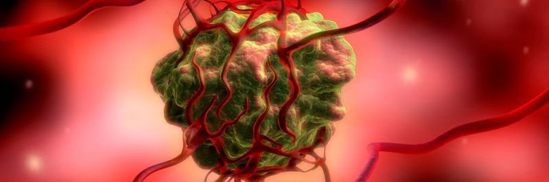Krebsgeschwüre sind in der Regel stärker arteriell durchblutet als gesundes Gewebe. Deshalb sollen sich die strahlenden Kügelchen vor allem im Tumor anreichern.