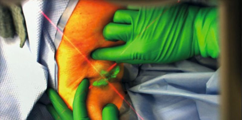 3D ARILE von Fraunhofer: Visuelle Markierungen, ausgehend von einer 3D-Brille, vereinfachen eine Operation.