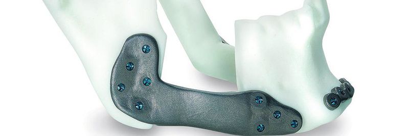 Hohe Passgenauigkeit: Additiv gefertigtes, kraniomaxillofaziales, patientenindividuelles Implantat.