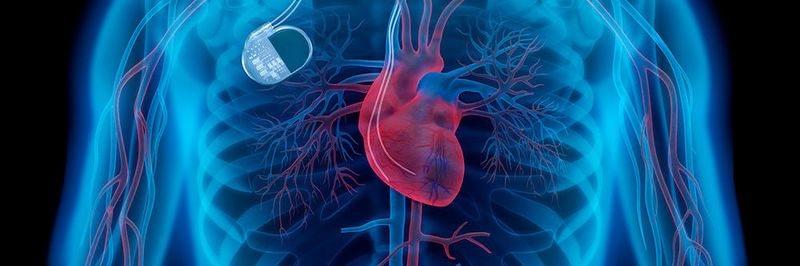 Es wird ein zentrales Register für Implantate wie beispielsweise Herzschrittmacher geben