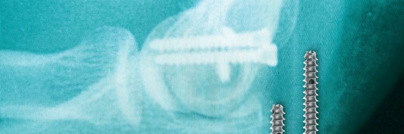 Ein Osteosynthese-System besteht aus einer der Anatomie angepassten Platte, die mit einer unterschiedlichen Anzahl von Schrauben in unterschiedlichen Längen und Durchmessern in die Knochen geschraubt werden.