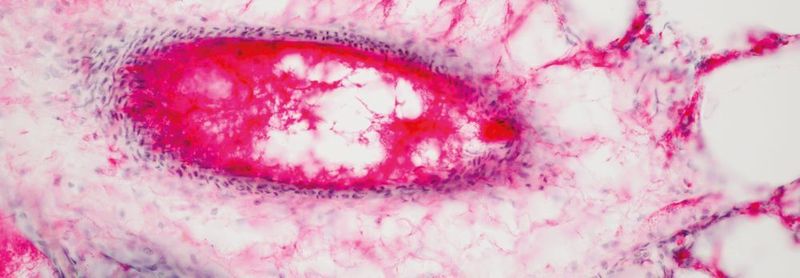 Abb. 1: Krebsdiagnostik: Ob Gewebe bösartig entartet ist, wird häufig anhand einer dem Körper entnommenen Gewebeprobe beurteilt. Im Bild: mikroskopische Darstellung von menschlichem Lungengewebe.