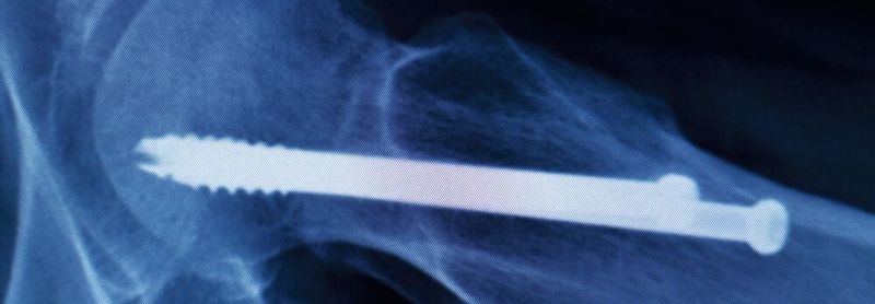 Abb. 1: Sie stabilisieren beispielsweise verletzte Knochen und ermöglichen so deren Heilung: Medizinische Implantate