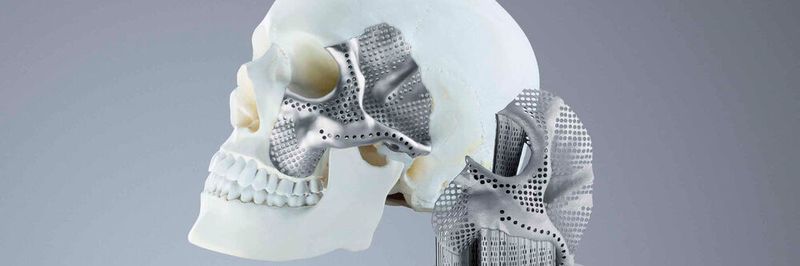 Der Medizintechnik-Hersteller Conmet produziert mit einem 3D-Drucker von Trumpf Schädel- und Kieferimplantate.