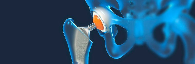 Daten zu den Implantaten müssen von Herstellern und Gesundheitseinrichtungen gemeldet werden
