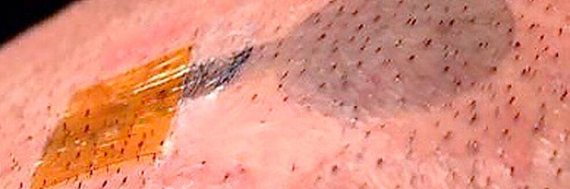 Die gedruckte Tattoo-Elektrode funktioniert selbst dann noch, wenn Haare durch das Tattoo wachsen und dabei kleine Risse verursachen.