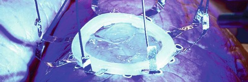 Eine neue Technik, die von Forschern der Universität von Minnesota entwickelt wurde, ermöglicht den 3D-Druck von Hydrogel-basierten Sensoren direkt auf Organe, die wie die Lunge ihre Form verändern oder sich durch Ausdehnen und Zusammenziehen verformen.