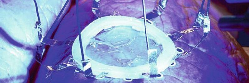 Eine neue Technik, die von Forschern der Universität von Minnesota entwickelt wurde, ermöglicht den 3D-Druck von Hydrogel-basierten Sensoren direkt auf Organe, die wie die Lunge ihre Form verändern oder sich durch Ausdehnen und Zusammenziehen verformen.