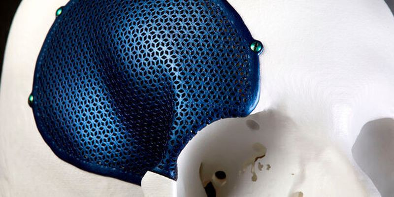 Materialise stellt viele personalisierte Medizinprodukte her, wie hier ein Titanimplantat für die Mund-Kiefer-Chirurgie. Dafür hat das Unternehmen jetzt eine CE-Kennzeichnung erhalten.