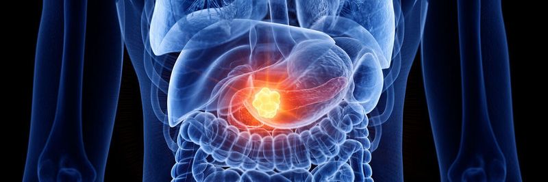 Künstliche Intelligenz statt Kontrastmittel: Bauchspeicheldrüsenkrebs per CT früh erkennen