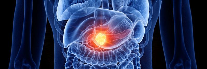 Künstliche Intelligenz statt Kontrastmittel: Bauchspeicheldrüsenkrebs per CT früh erkennen