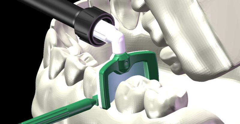 Ohne die Interdentalkeile kommt der Applikator nicht in die Zahnzwischenräume. Die Weltneuheit Icon DMG zur bohrerlosen Kariesbekämpfung wurde von Proto Labs gefertigt.
