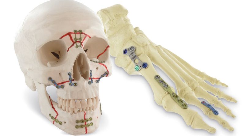 Von Kopf bis Fuß: Bei der Arno Fritz GmbH, einem Hersteller von Implantaten und Instrumenten für die MKG-, Hand- und Fußchirurgie, sorgt eine ERP/MES-Branchenlösung für die Medizintechnik durchgängig für Transparenz und Rückverfolgbarkeit.