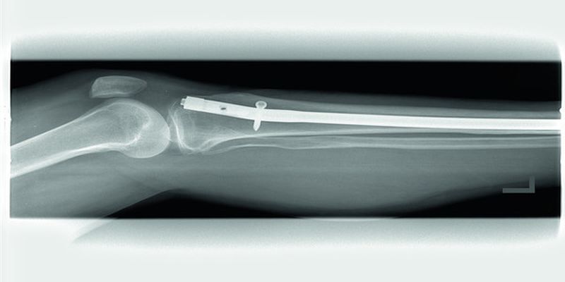 SMT entwickelt in Zusammenarbeit mit und für Kunden und Operateuren Instrumente, Implantate, Apparate und Sets für die Human- und Veterinärmedizin.