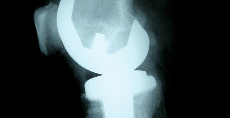 1 Auch medizinische Implantate und Prothesen müssen sicher sein und sind daher auf das Vorhandensein von Verbindungen zu untersuchen, die den Patienten gefährden können.