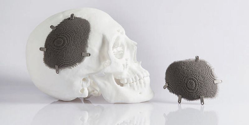 Schädelimplantat aus Titan: Die Porosität des Implantats beträgt 95 Prozent, sodass Flüssigkeiten mit wenig Widerstand abfließen und das Knochengewebe mit den Außenrändern verwachsen kann.