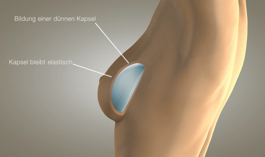 Brustimplantate Zeigen Weniger Nebeneffekte