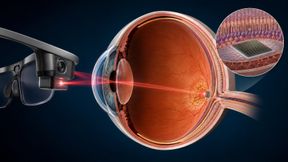 Eine kameragestützte Spezialbrille projiziert das aufbereitete Bild mit Nahinfrarotlicht auf den unter der Netzhaut liegenden Photovoltaikchip. Dessen 378 Pixel stimulieren verbliebene Bipolarzellen und erzeugen eine künstliche zentrale Formwahrnehmung. (Bild: Guido Deußing, nach Holz et al., N Engl J Med. 2026;394(3):232–242, DOI: 10.1056/NEJMoa2501396; Produktinformationen Science Corporation)