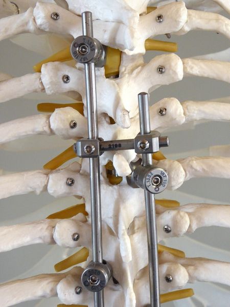 Die SMT Schilling Metalltechnik GmbH zählt zu den führenden deutschen Herstellern von Instrumentarium zur Implantation und Explantation von Implantaten im Bereich der Wirbelsäule und der allgemeinen Knochenchirurgie. (Bild: Kuhn)