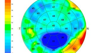 Zeiss Cirrus Epithelial Thickness Mapping (Zeiss)