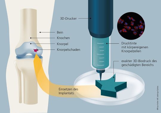 3D-Biodruck: Personalisierte Knorpelzellimplantate aus dem 3D-Drucker sollen zukünftig defekten Knorpel ersetzen. Die dabei verwendete Druckertinte enthält körpereigene Knorpelzellen.(Bild:  Fraunhofer IAP / Jadwiga Galties)