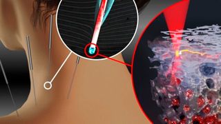 That 3D printing through an optical fiber is fundamentally possible was already demonstrated in the predecessor project "EndoPrint3D": An endoscopic bio-3D printer is intended to minimally invasively repair organ damage inside the body. For this purpose, a bio-photoresist is microfluidically applied directly to a damaged organ, and the extracellular matrix is printed on-site using two-photon lithography. (Image:University of Stuttgart, Kai Hirzel/IBBS, Timo Gissibl/4PI 4, Florian Sterl/Sterltech Optics)