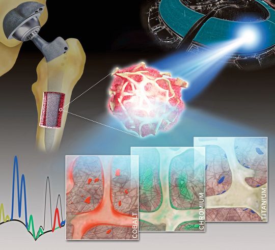 Räumlich hochaufgelöste Synchrotron-Röntgenfluoreszenzanalysen von humanen Knochen- und Knochenmark-Biopsien zeigen die spezifischen Verteilungsmuster von Metallen (Kobalt, Chrom und Titan), die aus Legierungen von Endoprothesen freigesetzt werden. Räumlich hochaufgelöste Synchrotron-Röntgenfluoreszenzanalysen von humanen Knochen- und Knochenmark-Biopsien zeigen die spezifischen Verteilungsmuster von Metallen (Kobalt, Chrom und Titan), die aus Legierungen von Endoprothesen freigesetzt werden.