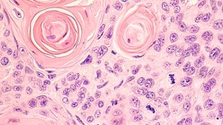 Imagen microscópica de una biopsia con aguja guiada por TAC, que muestra un carcinoma pulmonar de células escamosas, un tipo de carcinoma de células no pequeñas que suele estar relacionado con el tabaquismo. (Imagen:© David A Litman - stock.adobe.com)